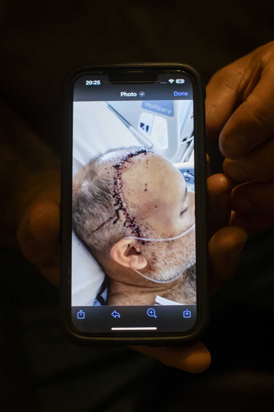 Mike Lozano displays a photo of himself after his surgery, seen on Saturday, August 31, 2024 at his home and Warhorse Ranch in Steamboat Springs, Colorado.